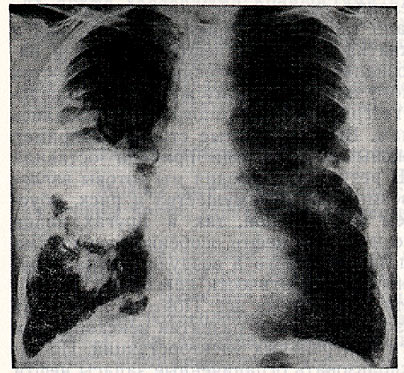 Рентгенограмма грудной клетки 66-летнего шахтера искалеченного «болезнью черных легких» (антракозом).